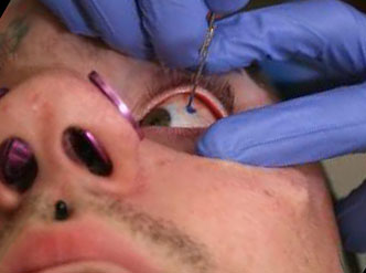 Tattoo on eyeball