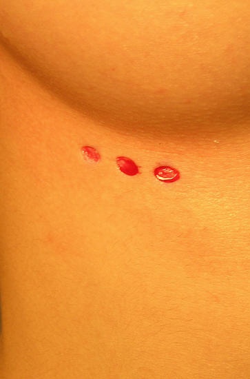 Circles cut into skin under boob