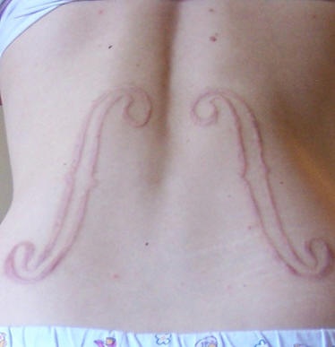 Skin scarification violin marks