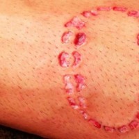 Awesome human bite skin scarification